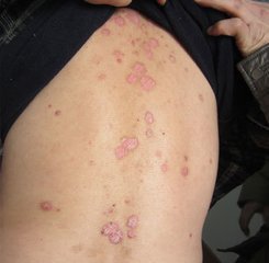 关节型牛皮癣的护理方法有哪些呢