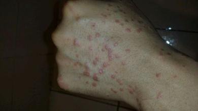 对称性牛皮癣具体会有什么症状呢