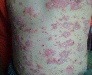 过敏体质银屑病患者该怎么治疗呢