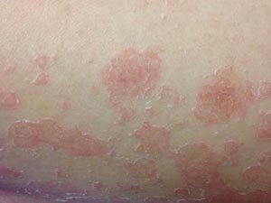 高温会是诱发牛皮癣的病因吗