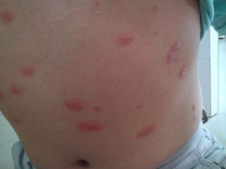 偏方治疗银屑病要注意什么呢