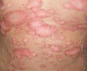 如何做好儿童牛皮癣的预防呢