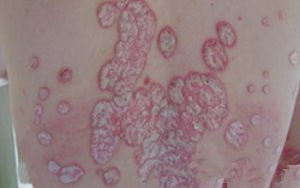 银屑病会给青少年造成什么样的危害呢