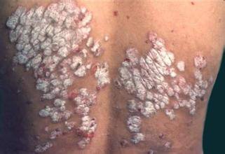 中老年牛皮癣治疗要选择什么方法好呢