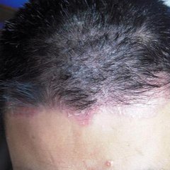 男性患银屑病的原因是什么呢