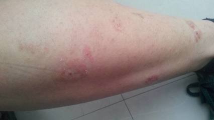 女性为什么容易患上牛皮癣呢