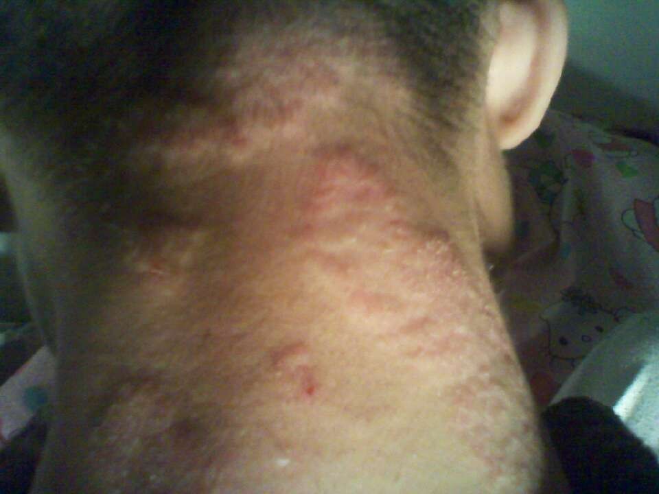 脖子上牛皮癣图片显示的症状