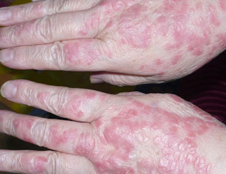 手部牛皮癣症状是什么样的