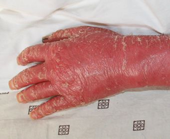 红皮牛皮癣症状图片什么样子