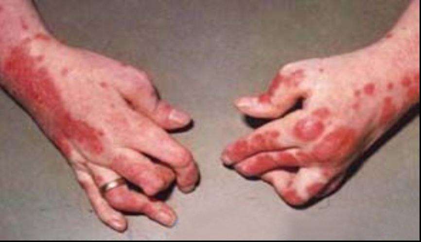 青年脓疱型牛皮癣表现有哪些