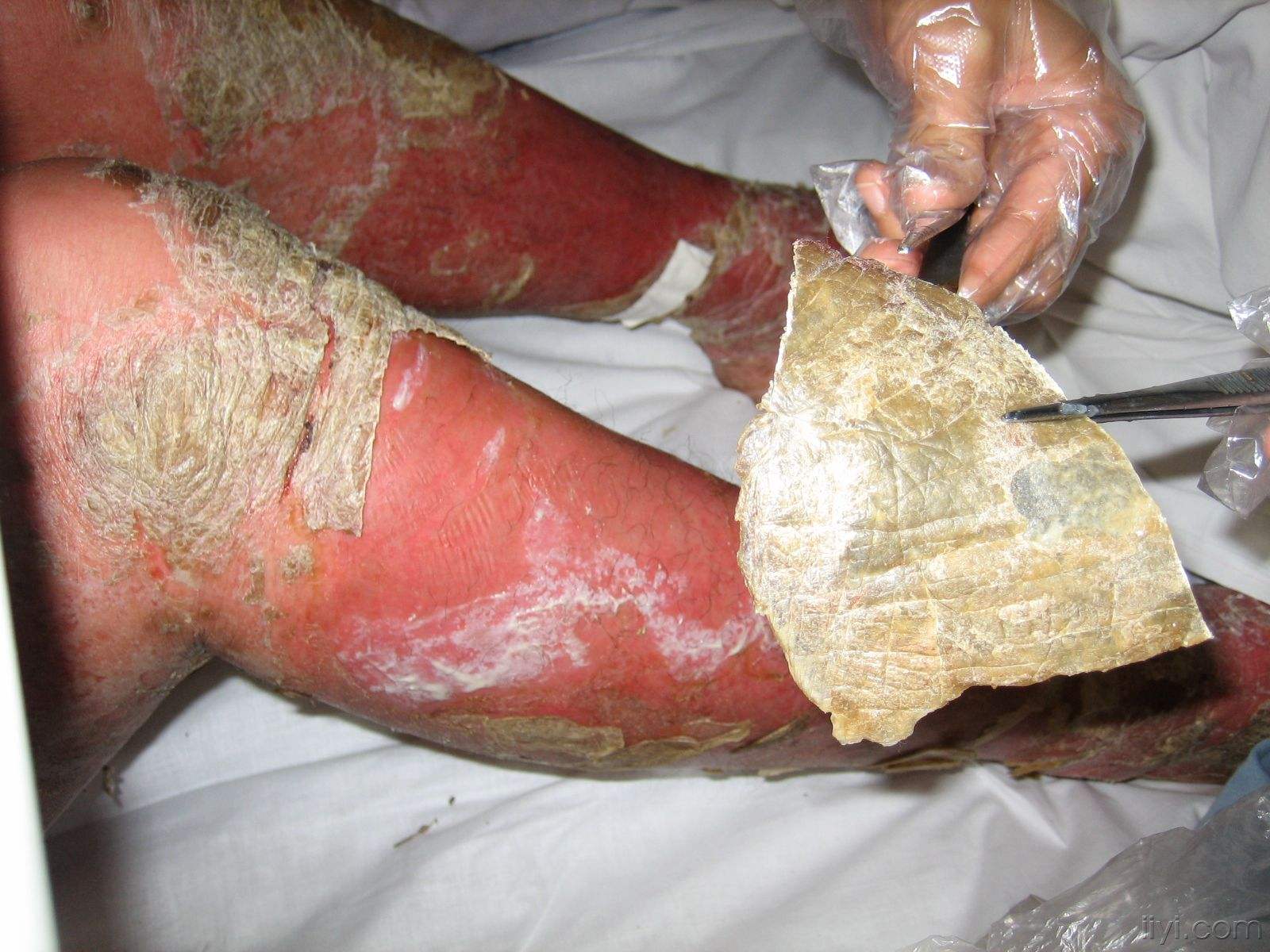 少年寻常型牛皮癣症状