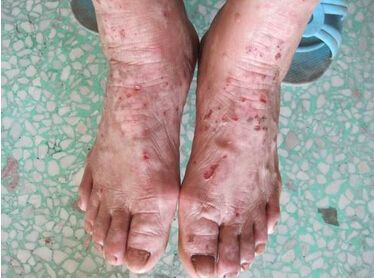 初期牛皮癣是什么样的