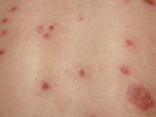 患者应该如何避免牛皮癣复发呢