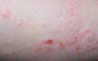 各类型银屑病有什么并发症呢