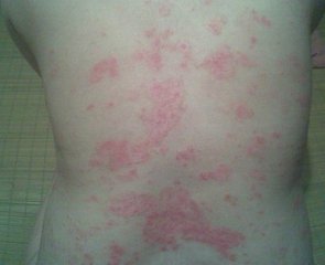 紫外线对牛皮癣患者有什么作用呢