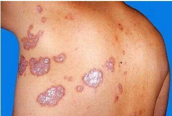 牛皮癣患者有什么方法舒缓压力呢