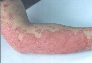 牛皮癣在夏季会因为什么原因复发呢