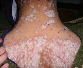 如何才能防止银屑病皮损扩散呢