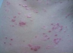 二手烟对牛皮癣患者的危害有什么呢