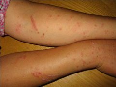 牛皮癣患者搓脚心养生有什么方法呢