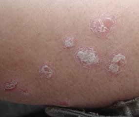 牛皮癣治疗效果可以怎么来判断呢