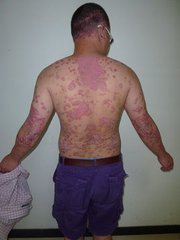 儿童牛皮癣要怎样护理患者呢