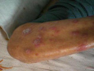 儿童牛皮癣要家长如何护理好呢