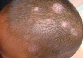 银屑病可引发哪些眼部的疾病呢