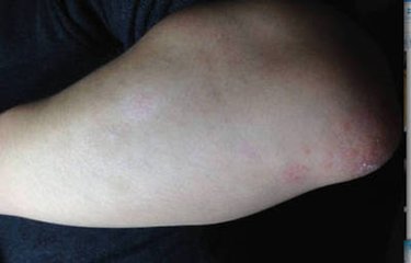 银屑病可引发哪些眼部的疾病呢