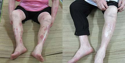 不同季节的银屑病各有什么特点呢